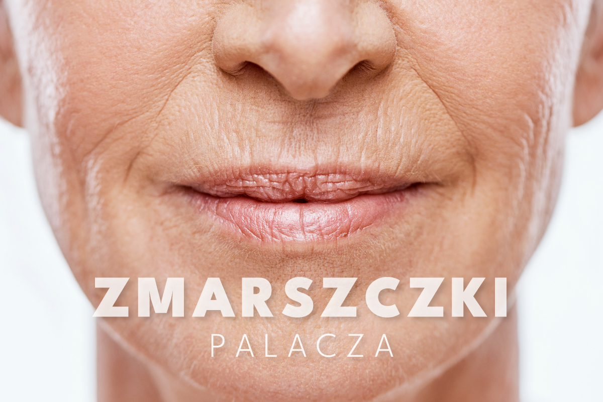 Zmarszczki palacza – jak zlikwidować je skutecznie?